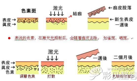 张光泽医生讲激光美容的原理