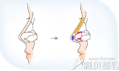 鼻小柱的延长的位置