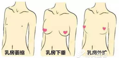 艾恩整形金承俊院长解说有乳腺增生是否可以做假体隆胸