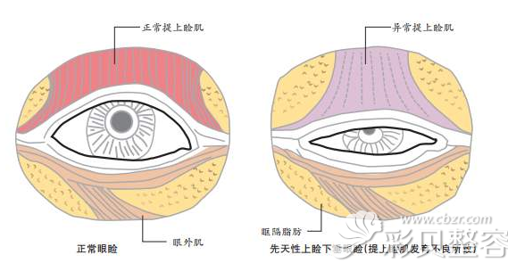 正常眼睑和异常眼睑的区别