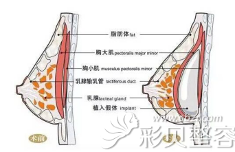 胸部假体安放位置