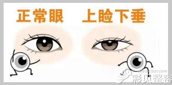 正常眼睛和上睑下垂的区别
