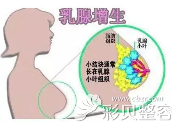 什么是乳腺增生