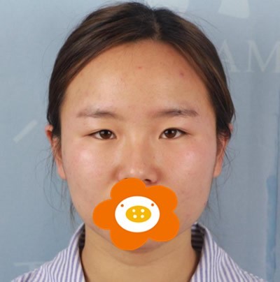 昆明李成龙医生切开双眼皮+开眼角综合眼整形术后干货分享