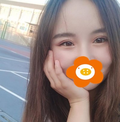 昆明李成龙医生切开双眼皮+开眼角综合眼整形术后干货分享