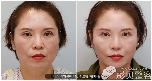 韩国艾恩许水源院长给客户玻尿酸注射法令纹的前后对比图