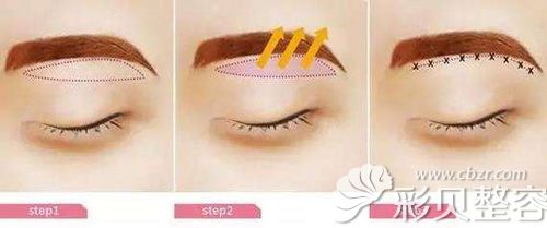 陈建忠医生给出提眉术的简易图