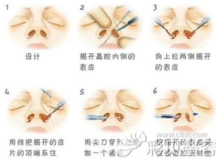 鼻翼缩小术的过程