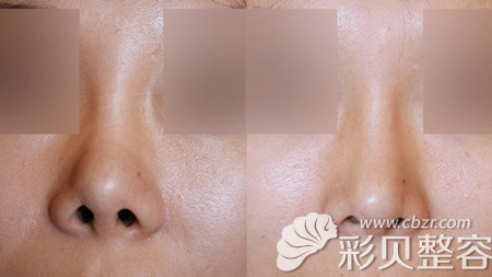 韩国艾恩崔源哲院长鼻翼缩小术术前术后对比图