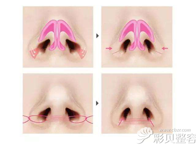 做鼻翼缩小术具体缩小的位置