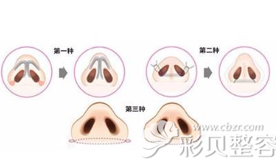 鼻翼缩小术的步骤