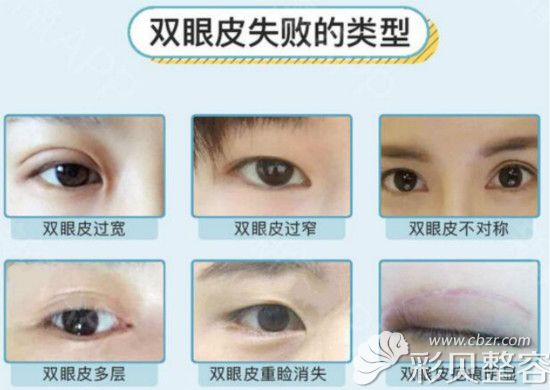 双眼皮失败常见六种类型