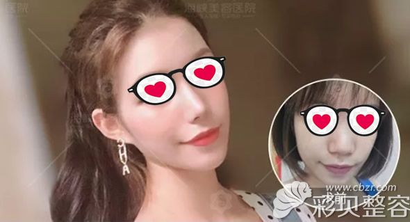 州海峡薛克墘医生膨体垫鼻梁+肋软骨垫鼻尖+鼻骨内推效果怎么样