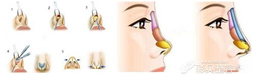 采用肋软骨做鼻部修复手术的原理图