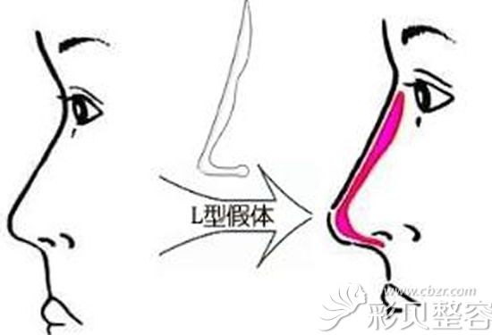 硅胶隆鼻示意图