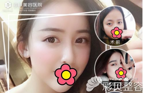 福州海峡医院眼综合整形案例