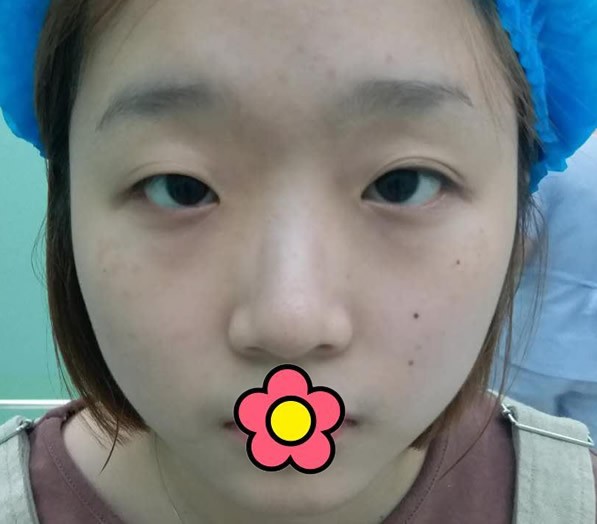 江西广济医院史希杰院长给我割双眼皮5个月了肉条早就没了!