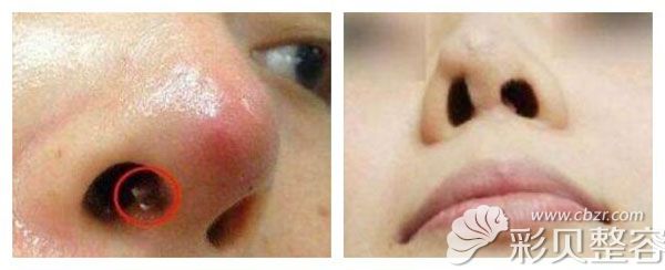 隆鼻失败的现象