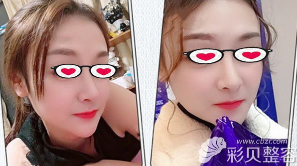 福州海峡医院真人埋线隆鼻案例