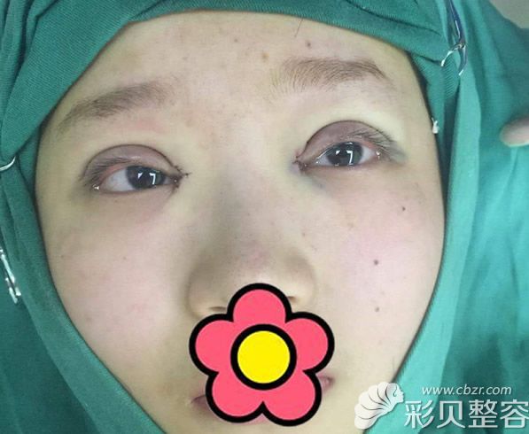 南昌广济医院割双眼皮后眼睛肿了
