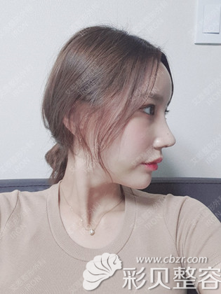 韩国艾恩整形埋线双眼皮+鼻综合+脂肪填充术后