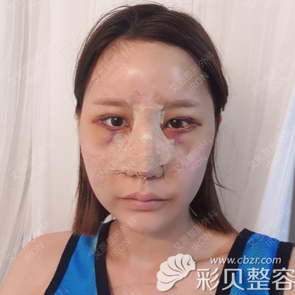 韩国艾恩鼻综合手术真人案例术后4天