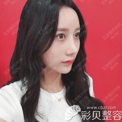 韩国艾恩埋线双眼皮+鼻综合+脂肪填充术后真人案例