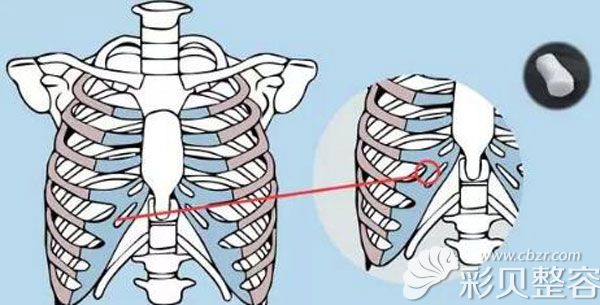 使用肋软骨做鼻尖会不会太硬