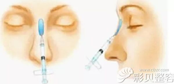 玻尿酸注射隆鼻示意图