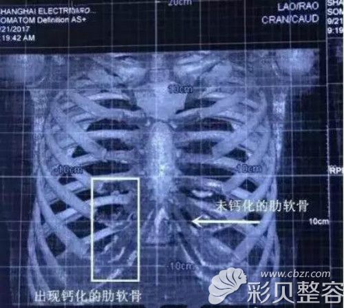 肋软骨拍CT结果图像