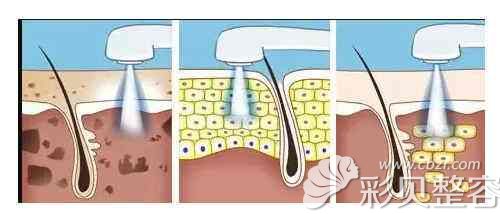 海峡整形张光泽医生说做光子嫩肤过程