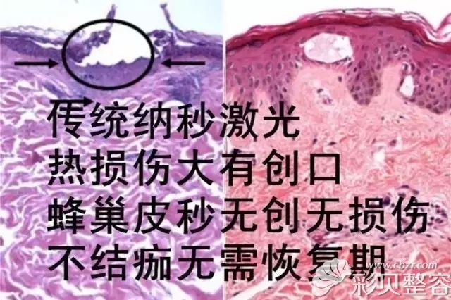 相比于传统激光，赛诺秀优势明显