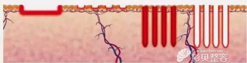 福州海峡专业医生张光泽说二氧化碳点阵激光的原理