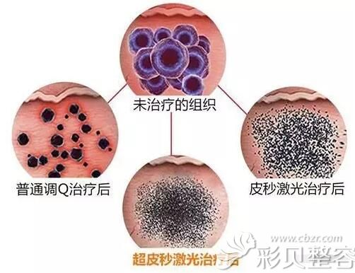 相比于传统激光，皮秒激光祛斑更<span style=