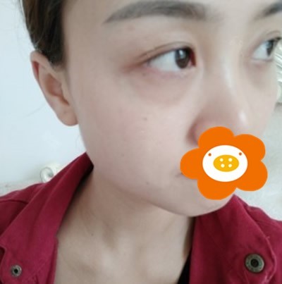 内切祛眼袋手术两个月恢复过程图反馈，确实让我年轻不少!