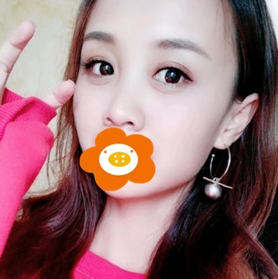 内切祛眼袋手术两个月恢复过程图反馈，确实让我年轻不少!