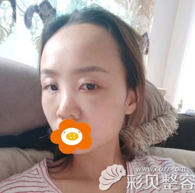 做完手术第3天肿的很厉害