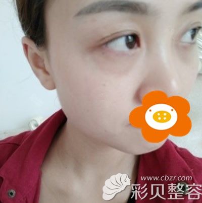 做祛眼袋手术前的我