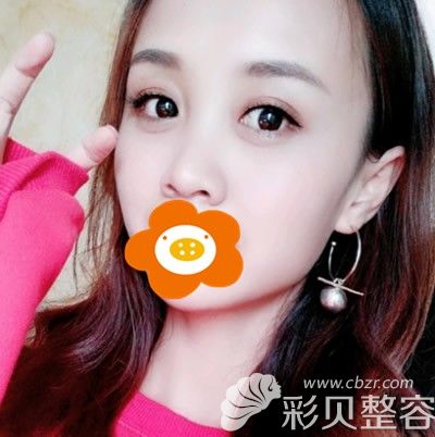 去眼袋手术术后两个月效果