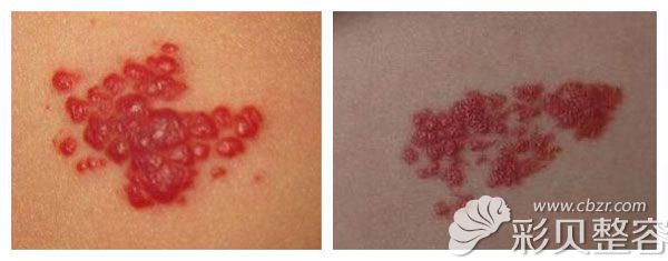 595和585激光治疗红色胎记哪个好