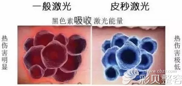 一般激光和皮秒激光的对比图