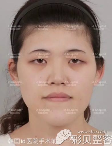 日本顾客在韩国做双鄂手术和眼鼻综合整形后变化太大了!