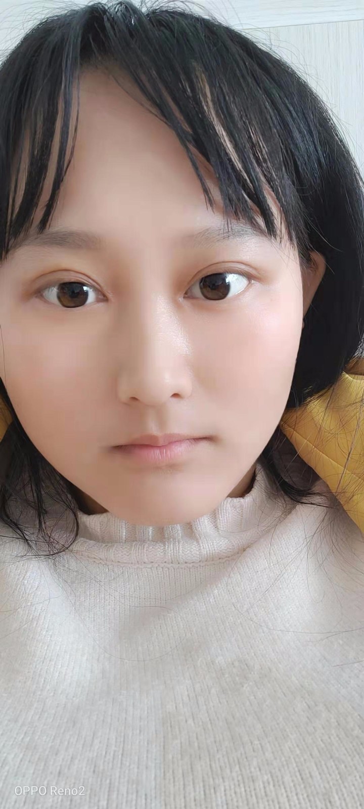 术前术后2月对比