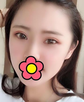 我做眼综合花了15000元,来瞅瞅术后200天恢复过程图!