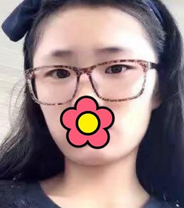 我做眼综合花了15000元,来瞅瞅术后200天恢复过程图!