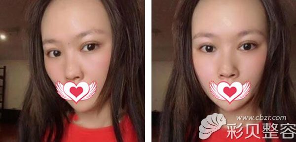 切开双眼皮恢复3个月的效果图