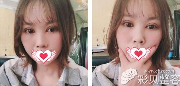 切开双眼皮第7天拆线眼睛有点肿