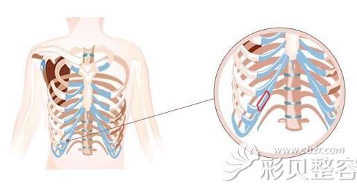 取肋软骨部位示意图