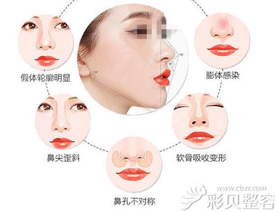 隆鼻失败症状 隆鼻失败症状