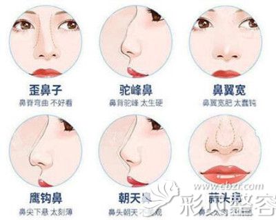 王锦文做鼻子解决不同鼻部缺陷问题